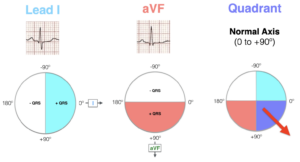 This diagram illustrates a normal axis with QRS complexes positive in leads I and aVF.