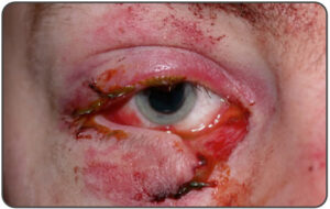 :This patient presents with a complex eyelid laceration possibly involving the canalicular system and should have a consultation with either ophthalmology or plastic surgery regarding repair.