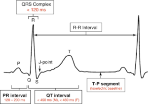 Use this diagram to identify ischemia through Q waves and ST segment changes.