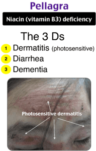 Teaching image of The 3 Ds: Dermatitis, Diarrhea, and Dementia (Pellagra, Vitamin B3, Niacin Deficiency)