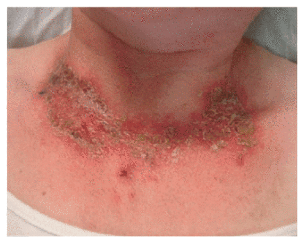 Close-up image of Pellagra rash neck