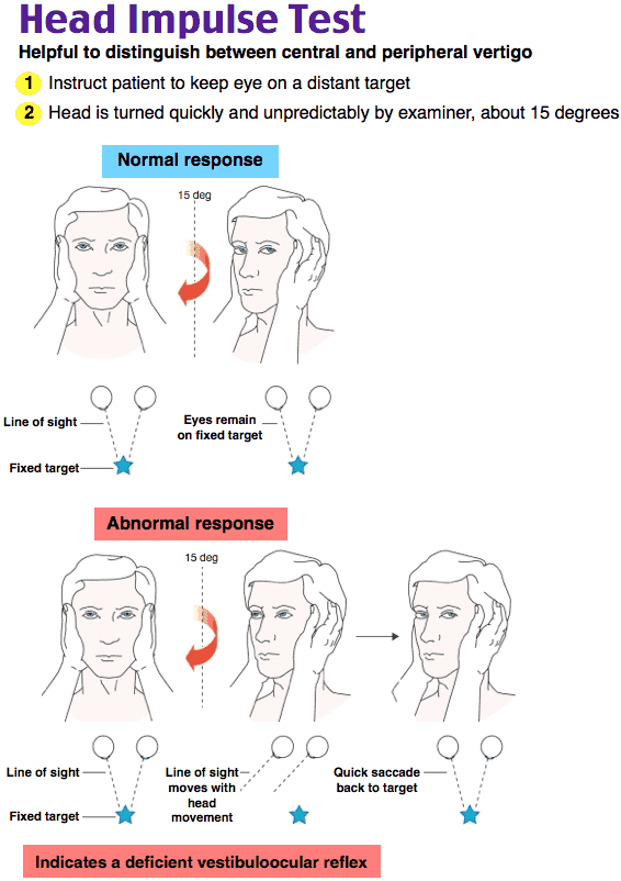 Head impulse test